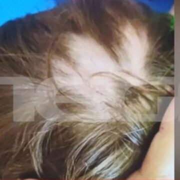 Μητέρα κατήγγειλε τον τραυματισμό 3χρονου γιου της σε ιδιωτικό σχολείο