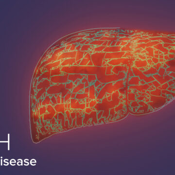 Δωρεάν έλεγχος για τη νόσο MASH